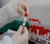 3 deaths, 862 new infections with the â€œCoronaâ€ virus, and 144 recoveries