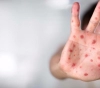 160 cases of measles in Gaza