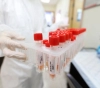 Health: 11 deaths and 491 new cases of Corona