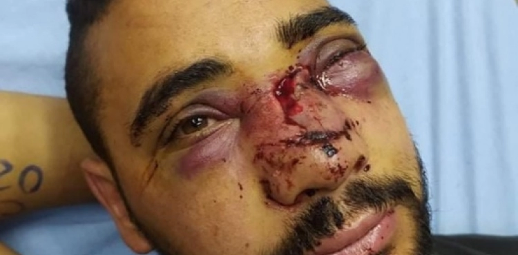Louay Abu Zaitoun.. The occupation disfigured his face and damaged the cornea of â€‹â€‹his eye when he was arrested